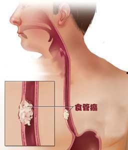 肿瘤 发生背景,肿瘤发生背景下的疾病机制与防治策略